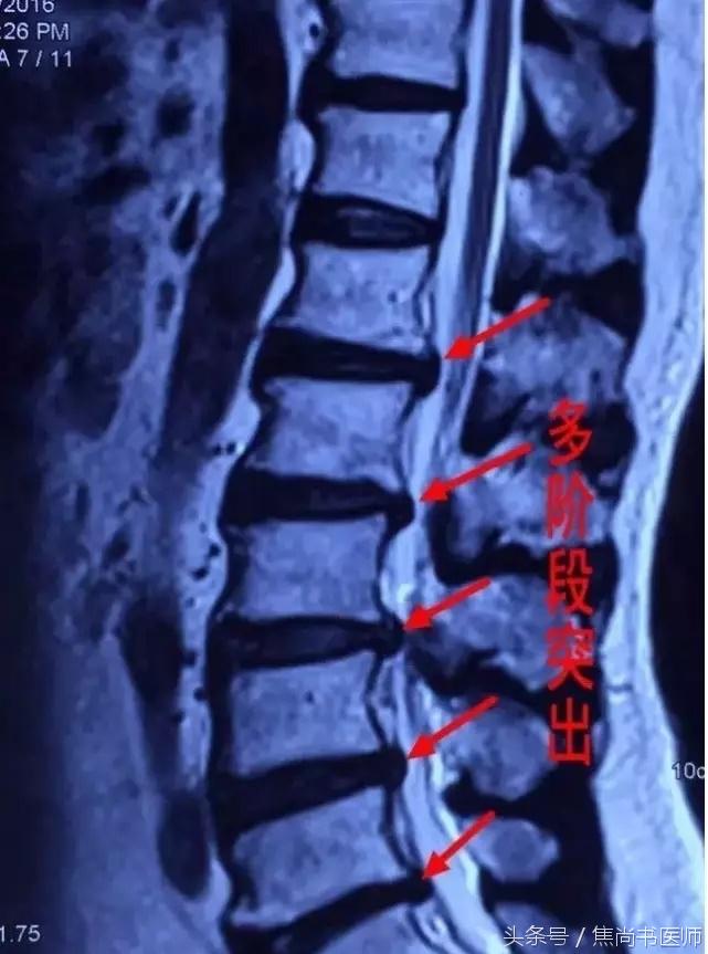 正骨法能不能治疗腰椎间盘突出,新医正骨可以治疗腰间盘突出症吗
