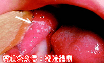 怎么确认宝宝是鹅口疮还是湿疹,婴幼儿鹅口疮症状