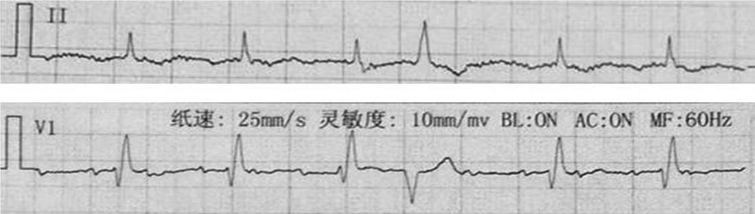严重的3度房室传导阻滞致死率,iii度房室传导阻滞发病原因
