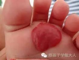 宝宝长雀斑样痣,宝宝长这种痣千万要关注
