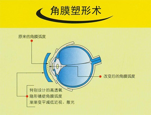 梦戴维角膜塑形镜危害,发烧戴角膜塑形镜危害