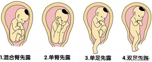 孕检临床诊断先兆流产怎么回事,流产胎儿基因检测