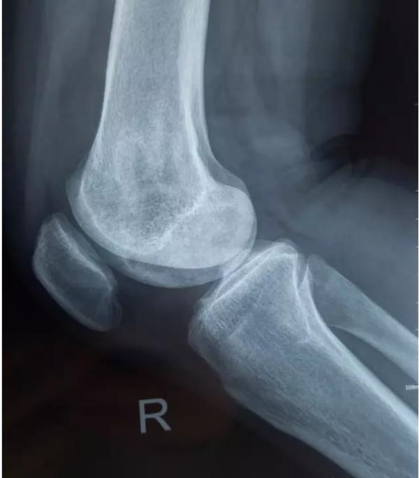 退行性骨关节炎的症状和治疗,退行性骨性关节炎分级