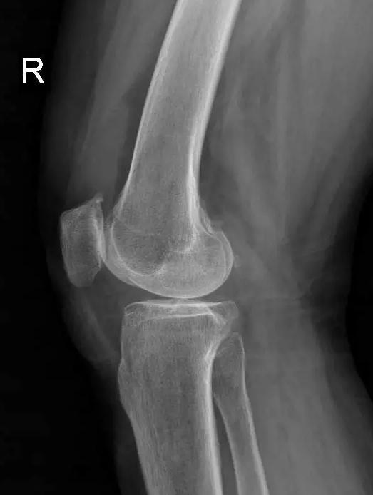 退行性骨关节炎的症状和治疗,退行性骨性关节炎分级