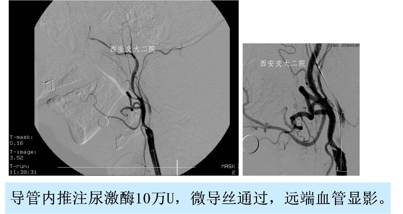 介入科病例,介入手术的健康科普方案