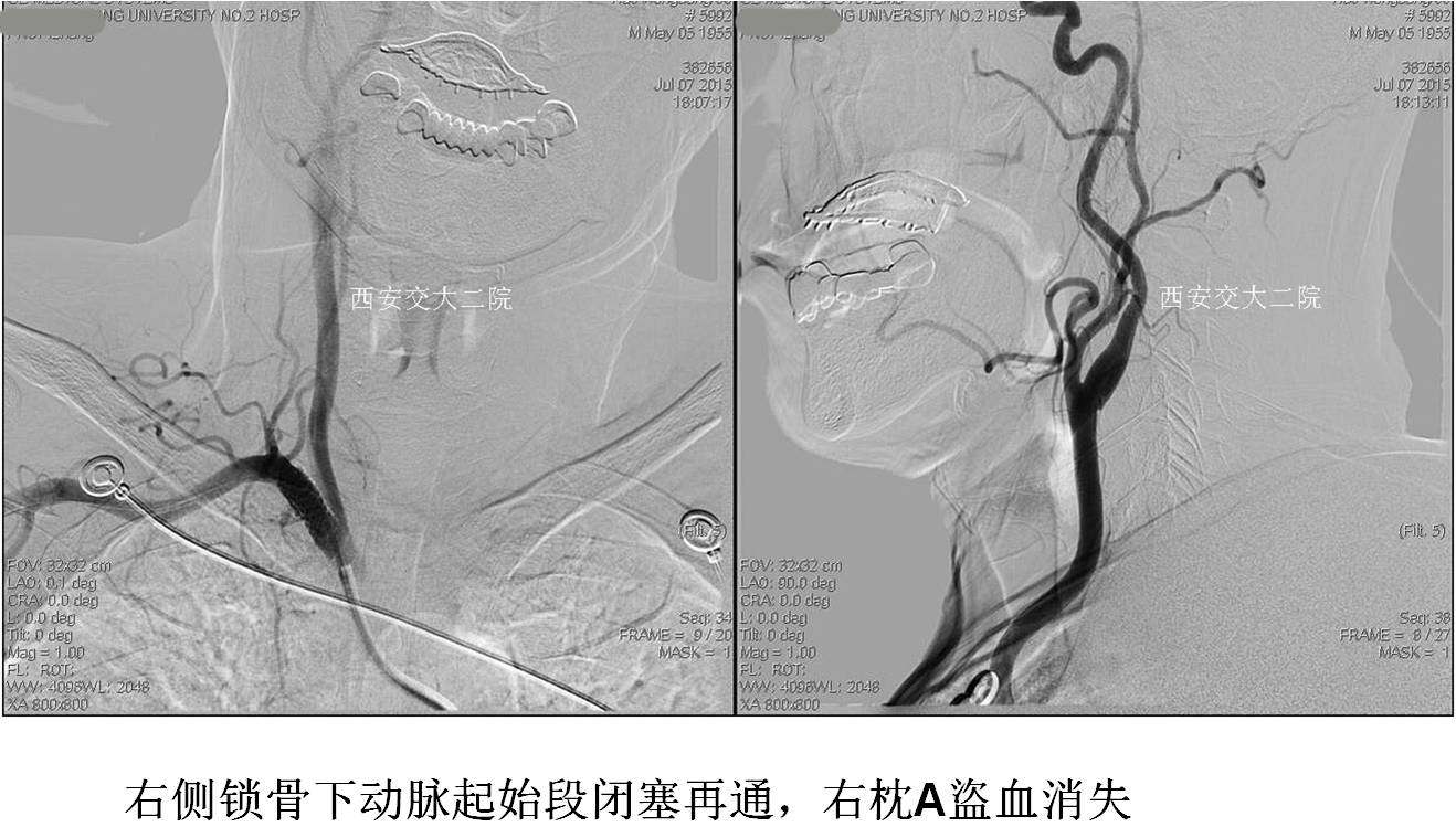 介入科病例,介入手术的健康科普方案