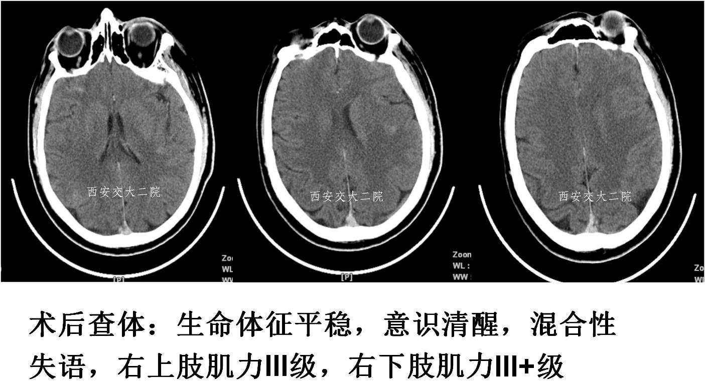 介入科病例,介入手术的健康科普方案