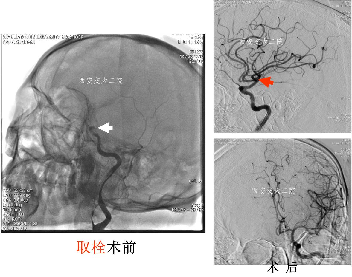 介入科病例,介入手术的健康科普方案