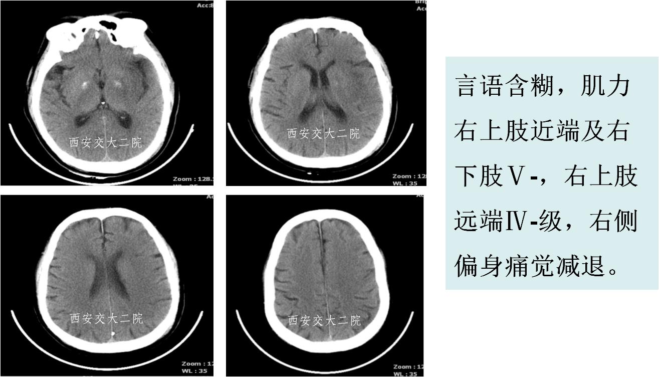 介入科病例,介入手术的健康科普方案