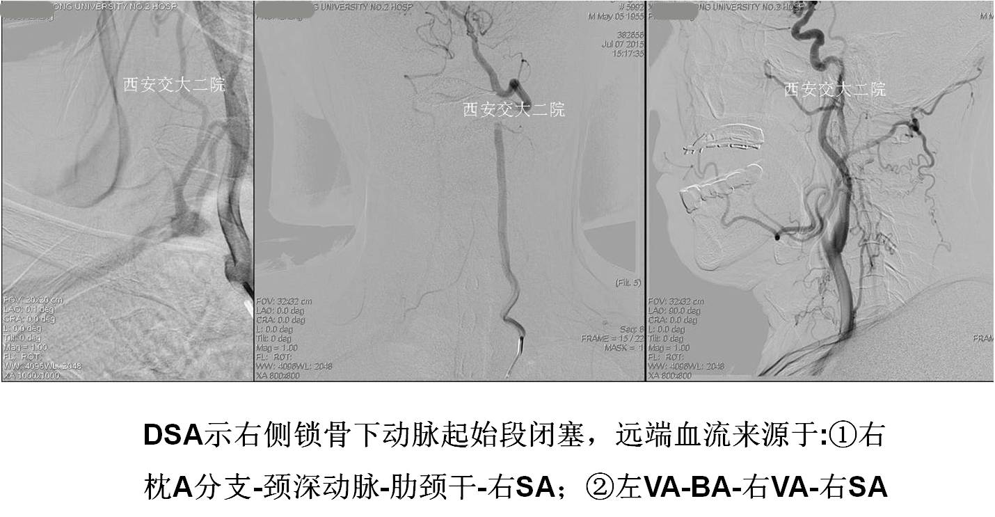 介入科病例,介入手术的健康科普方案