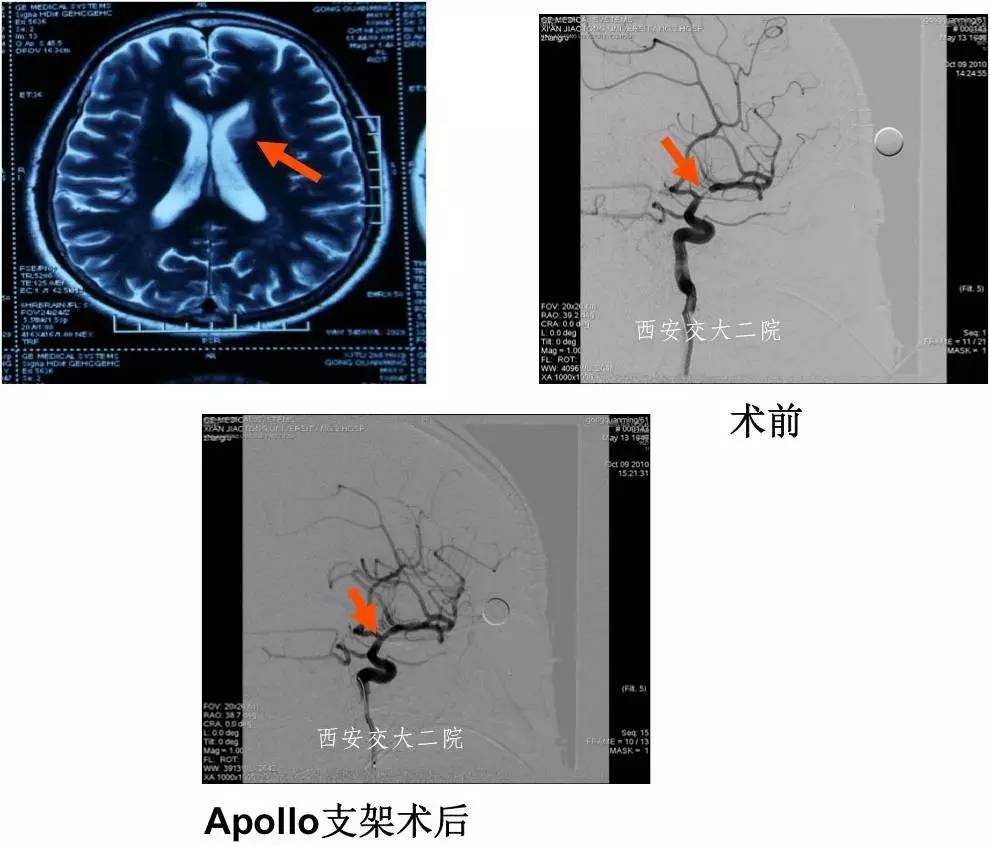 介入科病例,介入手术的健康科普方案