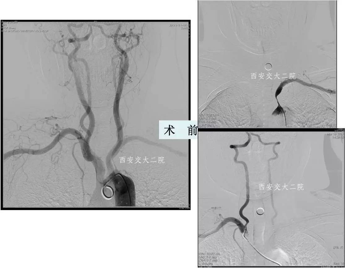 介入科病例,介入手术的健康科普方案