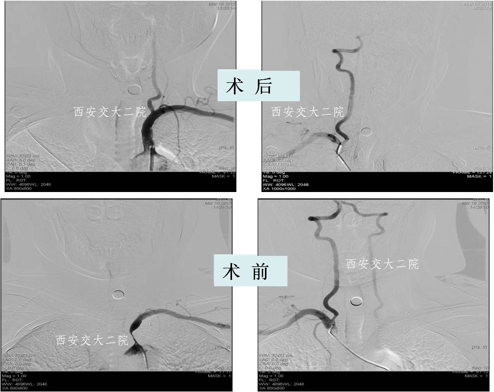 介入科病例,介入手术的健康科普方案