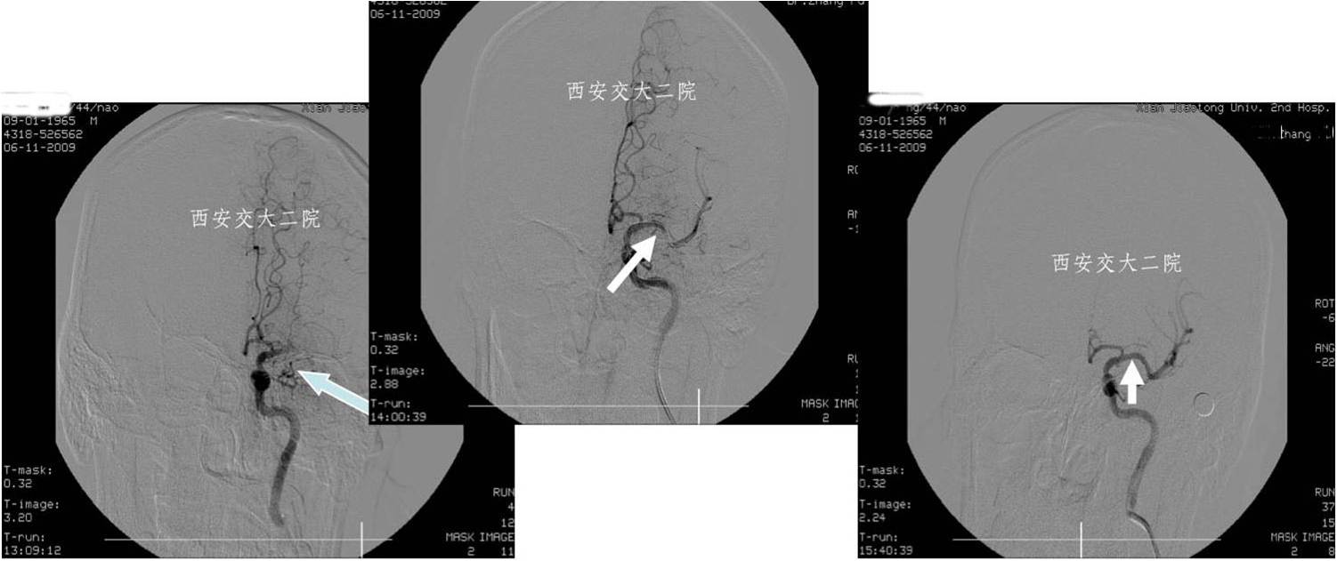 介入科病例,介入手术的健康科普方案