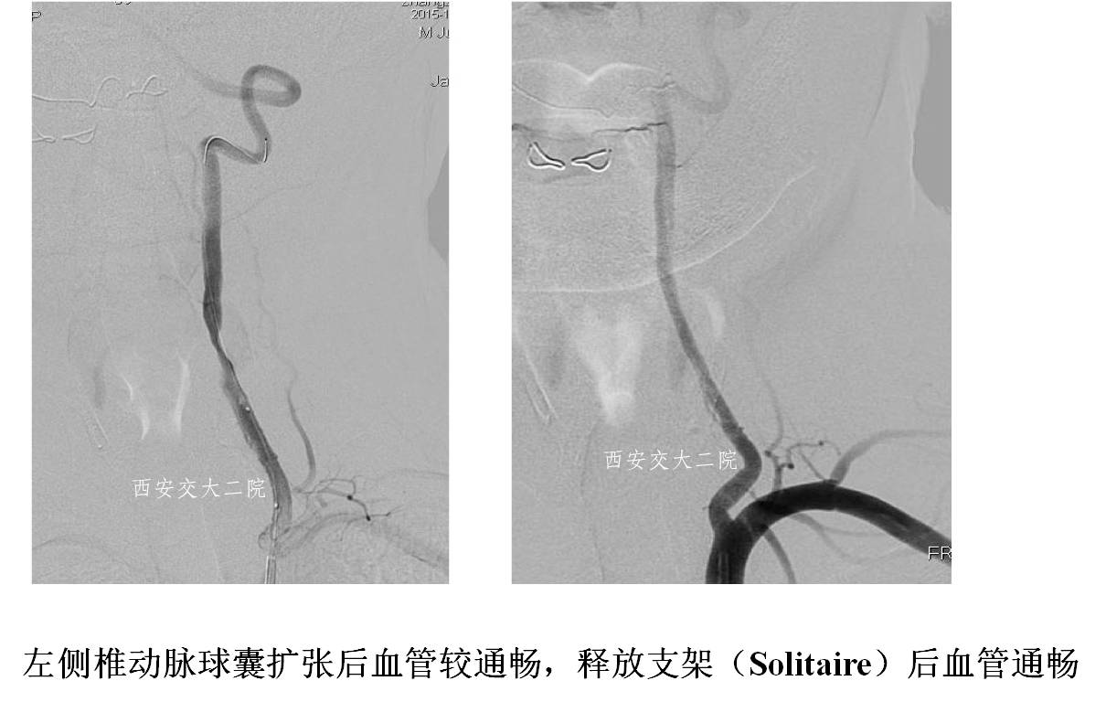 介入科病例,介入手术的健康科普方案