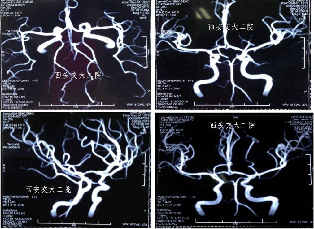 介入科病例,介入手术的健康科普方案