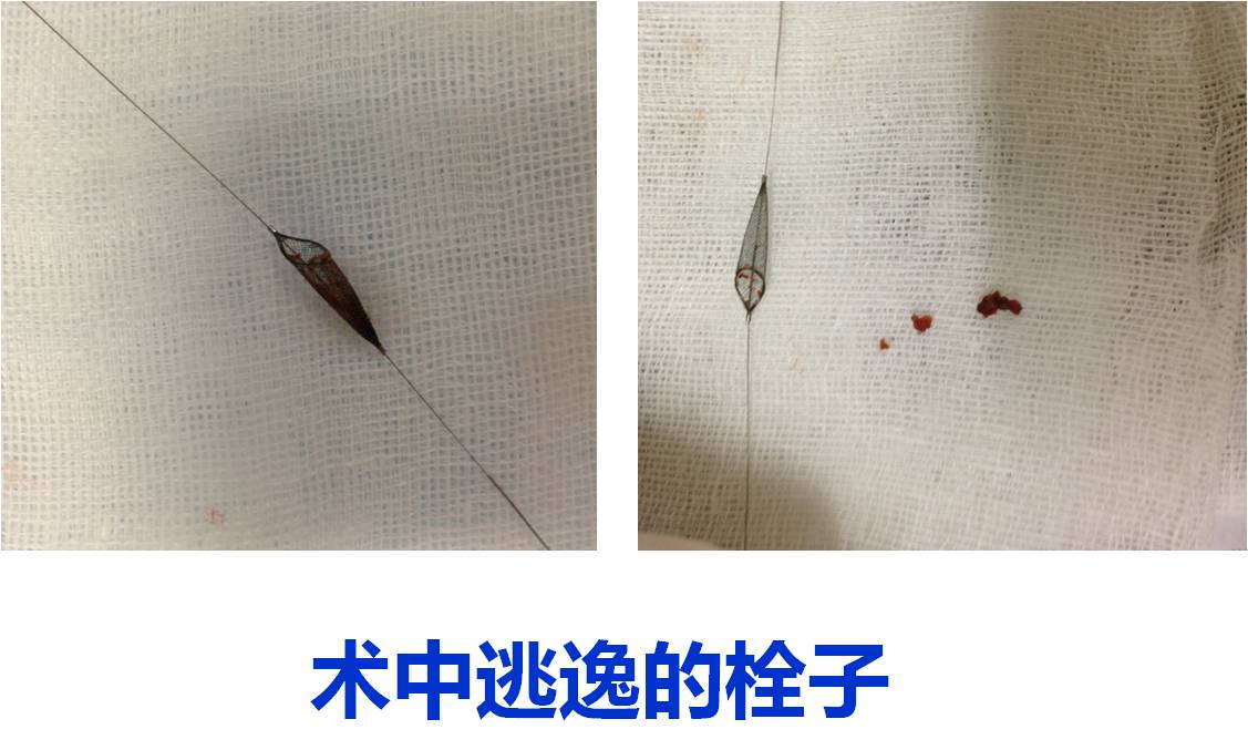 介入科病例,介入手术的健康科普方案