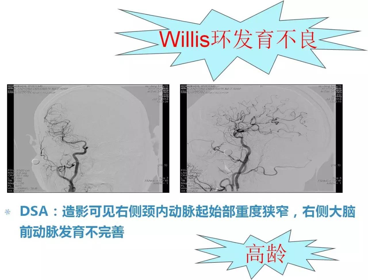 脑高灌注的处理措施,脑高灌注是什么意思