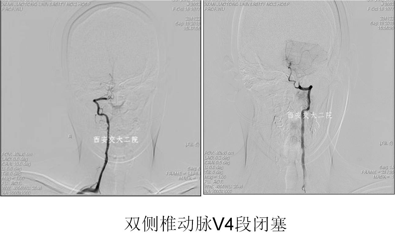 介入科病例,介入手术的健康科普方案