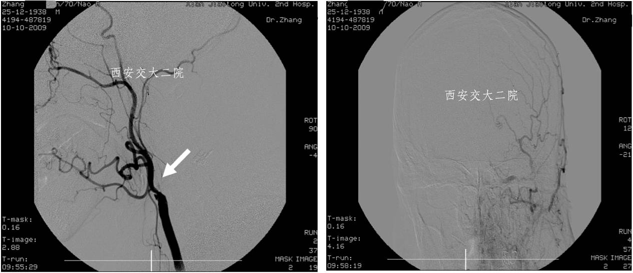 介入科病例,介入手术的健康科普方案
