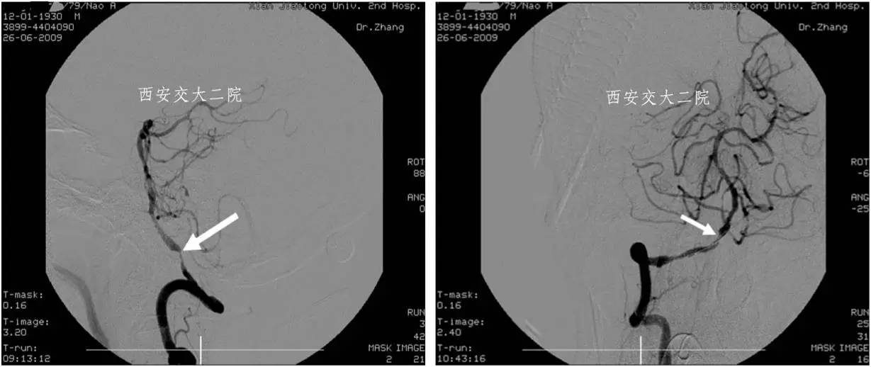 介入科病例,介入手术的健康科普方案