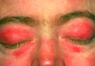 对力量的宣战--炎性肌病