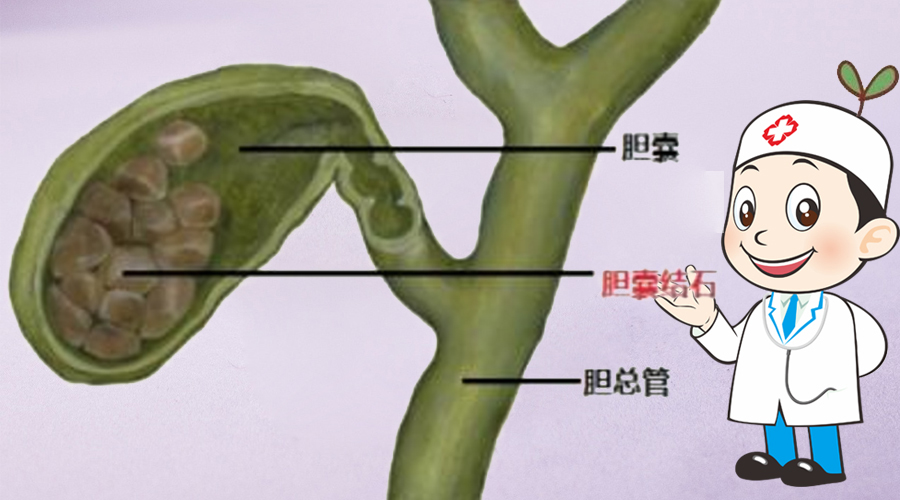 胆结石有没有必要保胆,17岁胆结石手术保胆好还是切除好