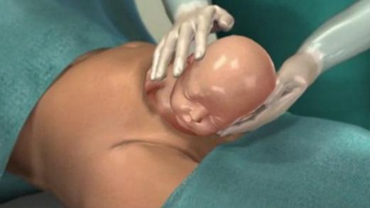 38岁产妇剖腹产经历,剖腹产38周宫缩是什么原因