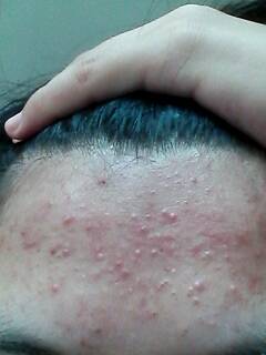 长水痘什么东西不能吃,长水痘能不能吃鸡蛋