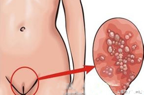 hpv检测16和66是阳性传染吗,hpv检测pccc阳性是什么意思