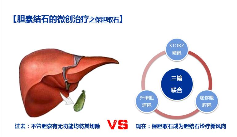 胆结石有没有必要保胆,17岁胆结石手术保胆好还是切除好