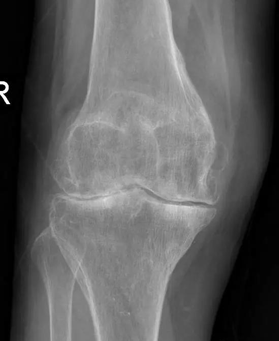 退行性骨关节炎的症状和治疗,退行性骨性关节炎分级