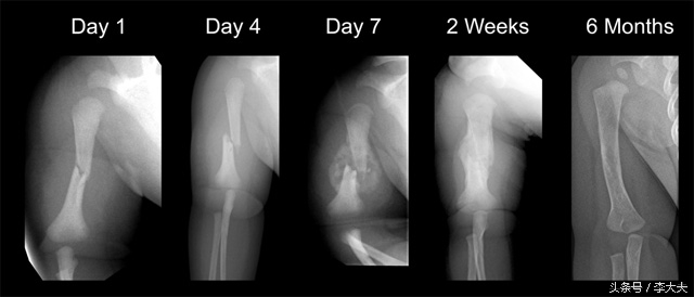 脑洞大开找出活下去的办法,断的骨头是怎样长回来的
