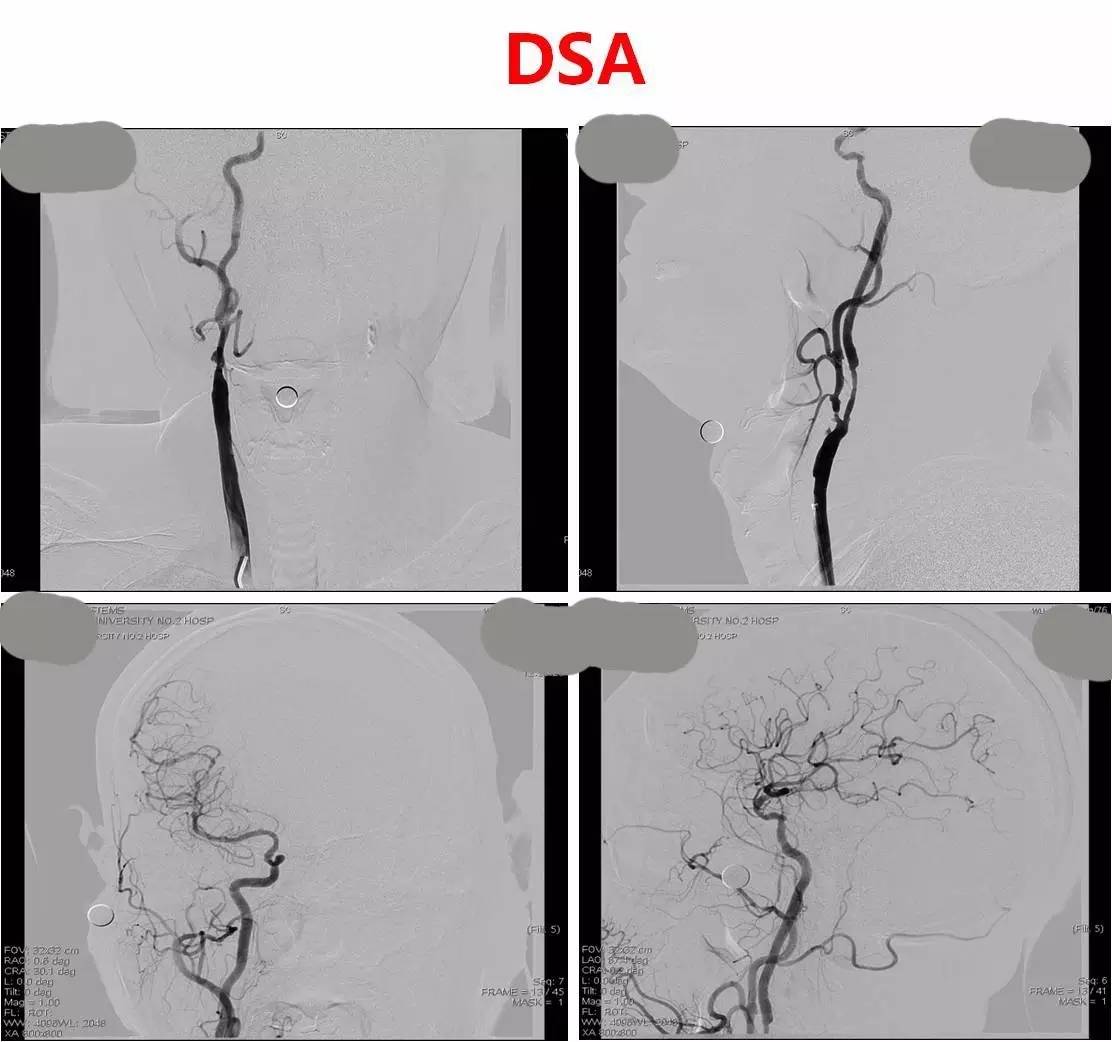 脑高灌注的处理措施,脑高灌注是什么意思