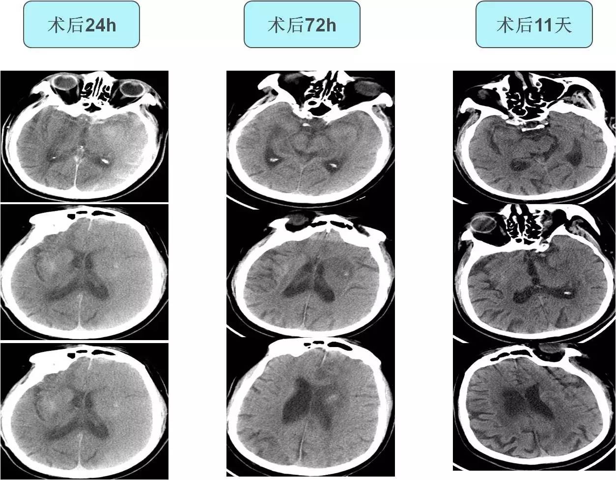 脑高灌注的处理措施,脑高灌注是什么意思