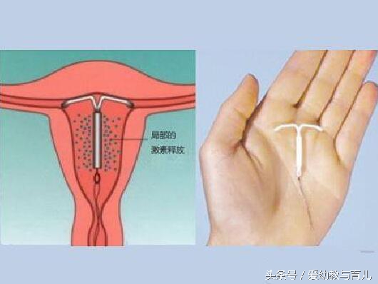 单亲孕妈流产,35宝妈四次剖腹产的经历