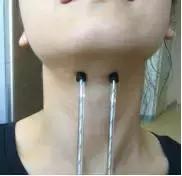 周惠嫦主任：鼻咽癌放疗后吞咽康复治疗的方法