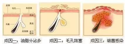 长痘尽量不吃什么,长痘尽量不要吃海鲜