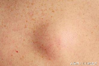 六个月宝宝左右手臂里面有硬块,宝宝手臂里有个硬块摸得到看不到