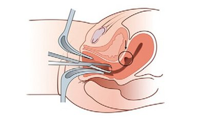 剖宫产术后子宫瘢痕憩室,剖宫产切口憩室再手术有危险吗