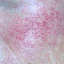 皮肤显现红血丝怎么回事,皮肤红血丝是怎么引起的