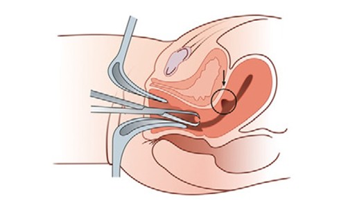 剖宫产术后——子宫多了个“小阁楼”?