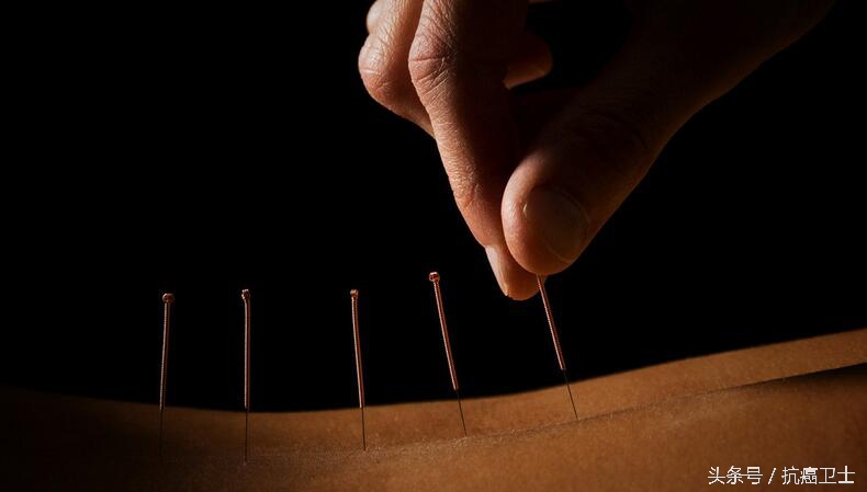 治水肿最好的针灸方法,三皇穴治疗双下肢水肿