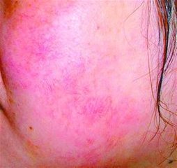 皮肤显现红血丝怎么回事,皮肤红血丝是怎么引起的