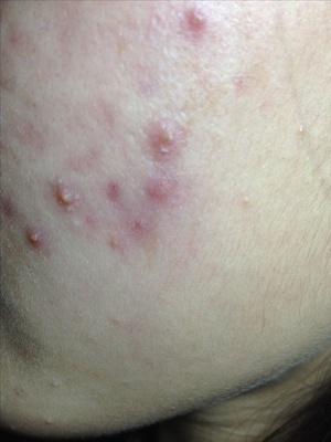 皮肤显现红血丝怎么回事,皮肤红血丝是怎么引起的