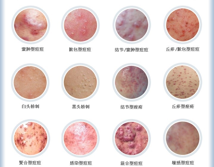 痘印怎么快速消除,痘痘怎么快速消除不留痘坑