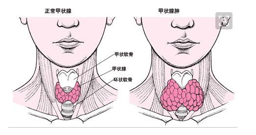 甲状腺囊肿最佳中药方,卵巢囊肿结节中药治疗配方