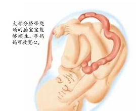 婴儿脐带绕颈迷信说法好吗,宝宝脐带绕颈导致缺氧生下来没哭
