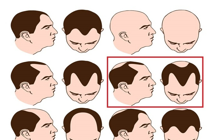 谢顶秃头怎么治疗,中医斑秃辨证分型