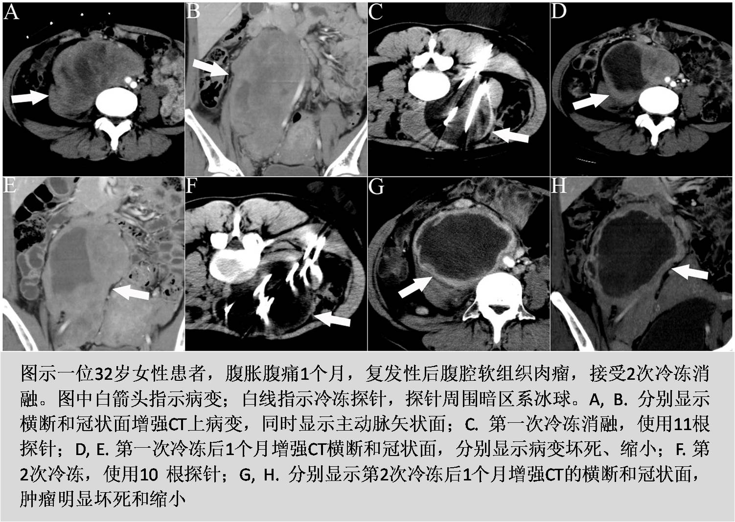 腹膜癌抗癌成功案例,肉瘤抗癌成功案例